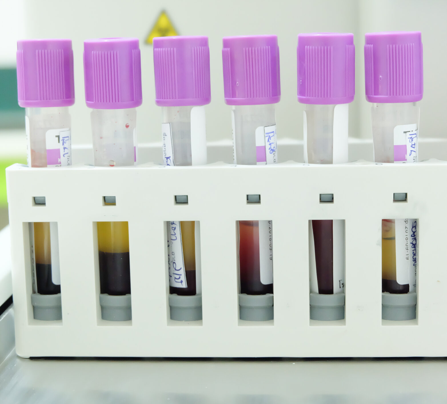 6 vials of blood sitting on a lab table